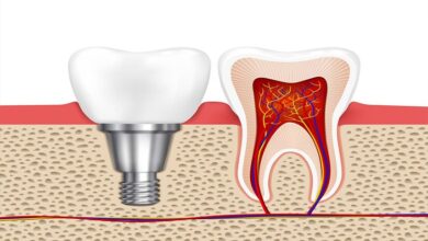 ایمپلنت ایرانی